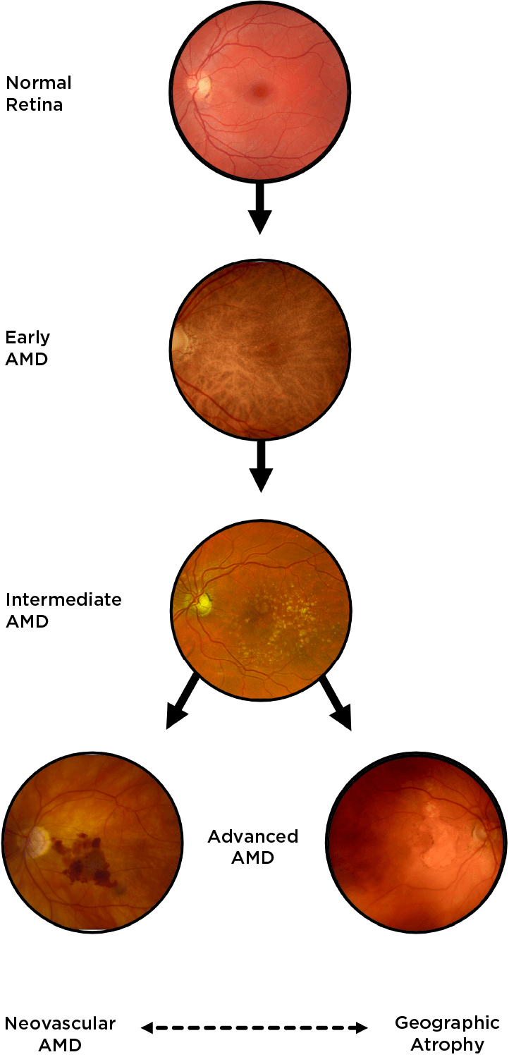 Flow chart of progression of a age-related macular degeneration to both GA and neovascular AMD