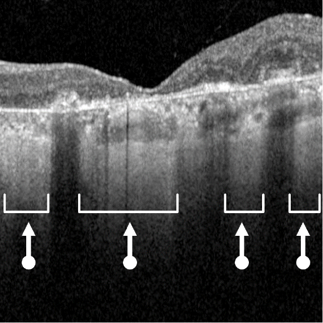 Optical coherence tomography (OCT) image of advanced AMD (GA) with atrophic lesions