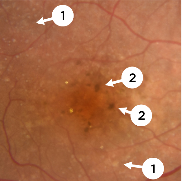 A color fundus photography (CFP) of intermediate AMD