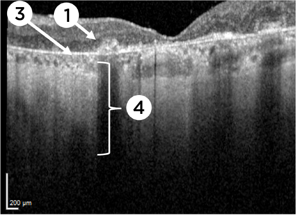 Optical coherence tomography (OCT) of geographic atrophy